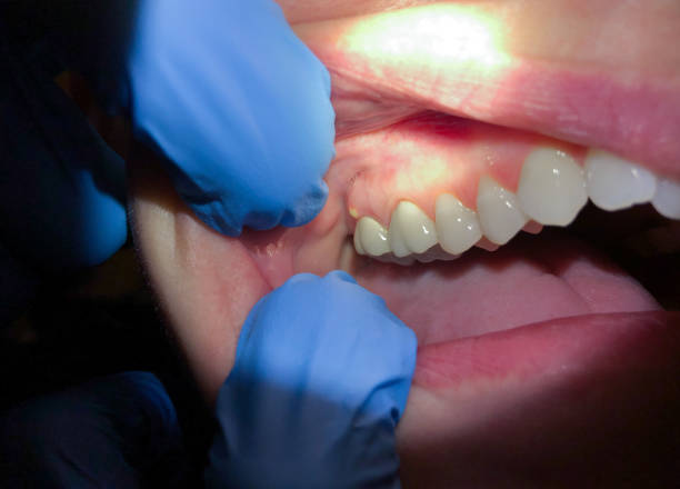 Best Broken or Chipped Tooth Repair in Camano, WA