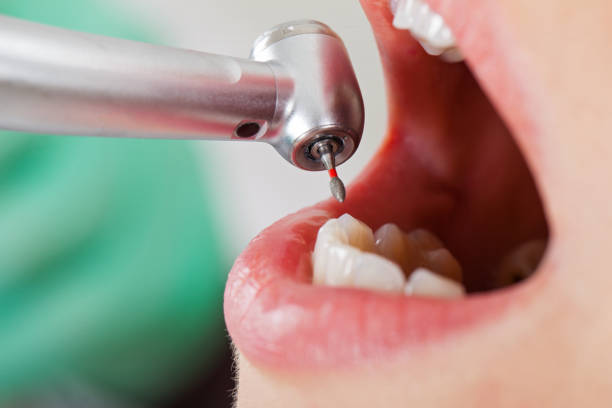 Best Emergency Treatment for Oral Infections in Camano, WA